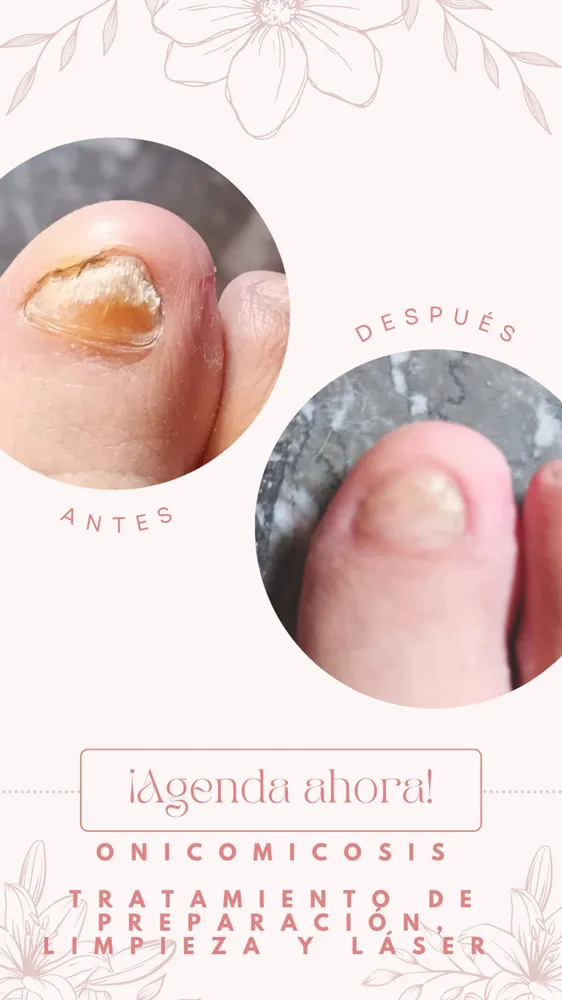 Onicomicosis laser  1