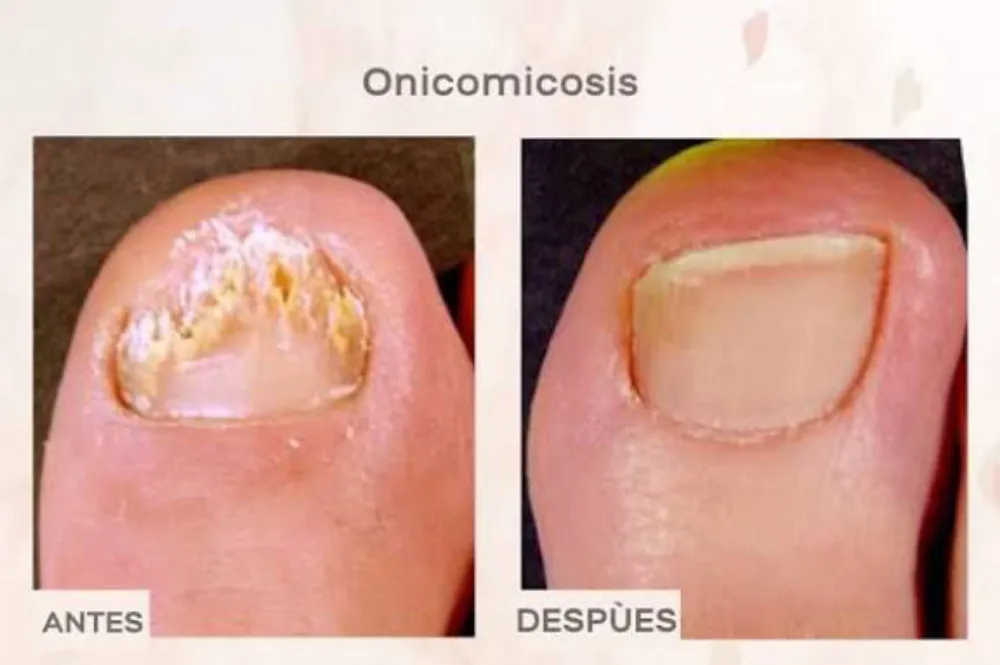 Onicomicosis laser  3