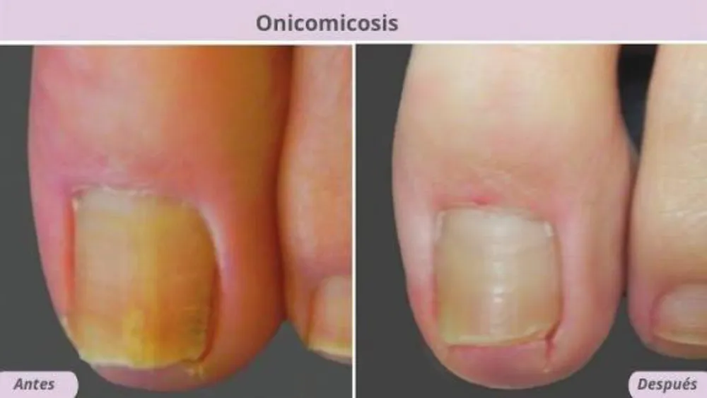 Onicomicosis laser  4