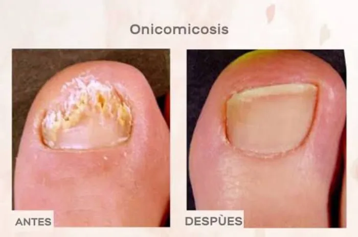 Onicomicosis láser  2