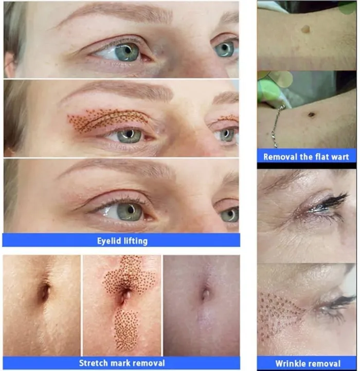 Plasmapen estetico  2