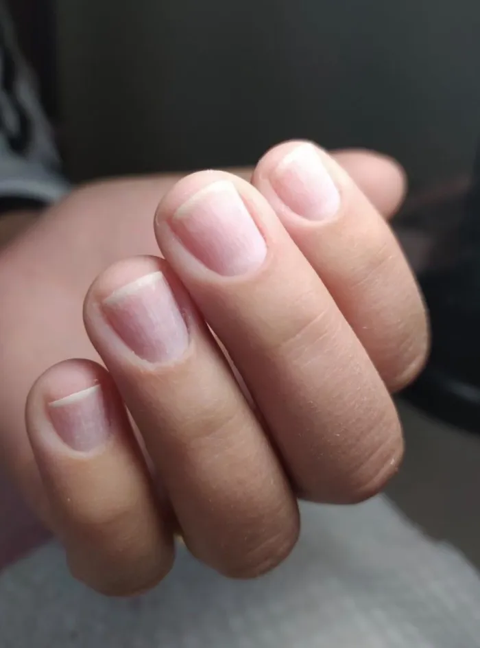 RETIRO DE UÑAS